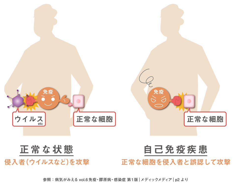 イラスト：自己免疫疾患のメカニズム