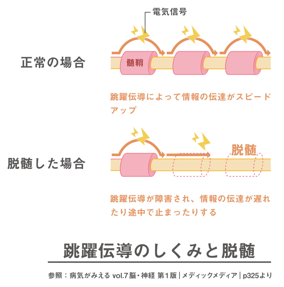 イラスト：跳躍伝導のしくみと脱髄